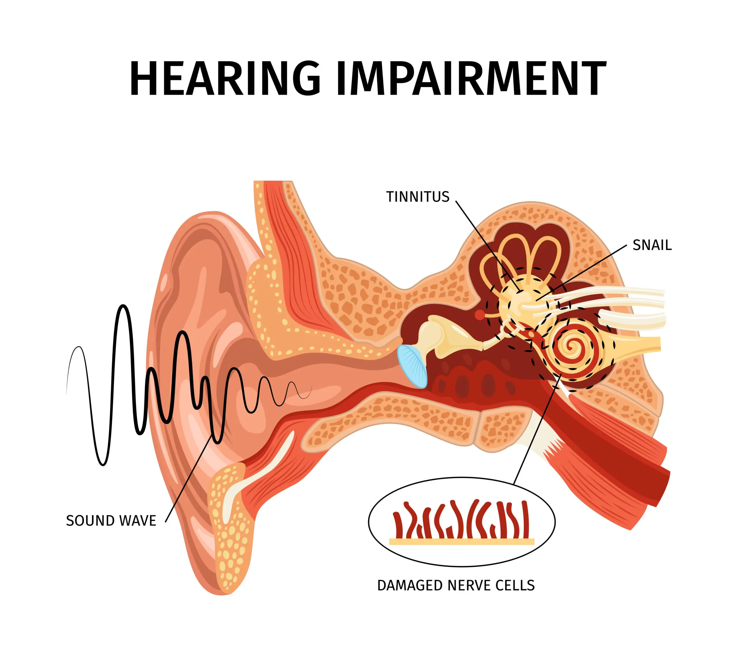 Illustration of the ear and cochlea showing how sound travels to the hearing nerve